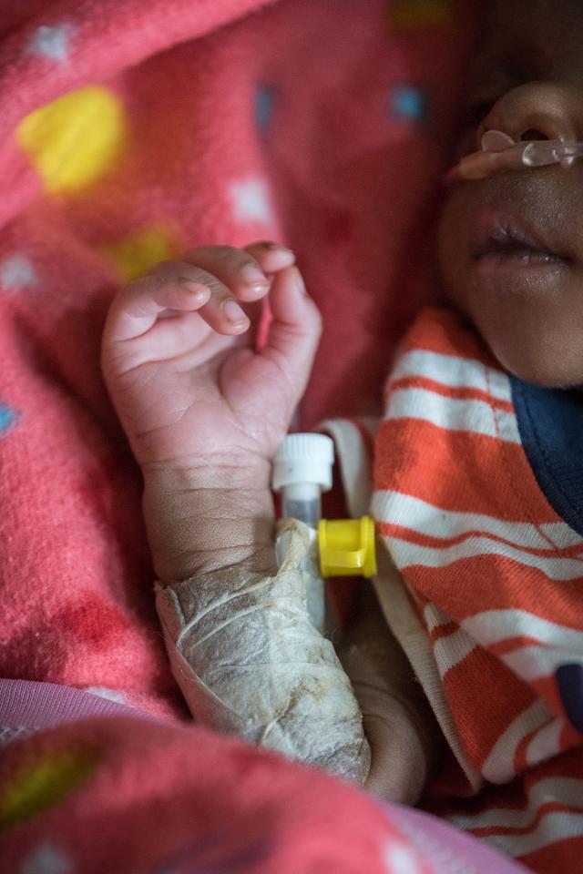 A child born in the seventh month of pregnancy receives support at Phebe Hospital, Liberia.